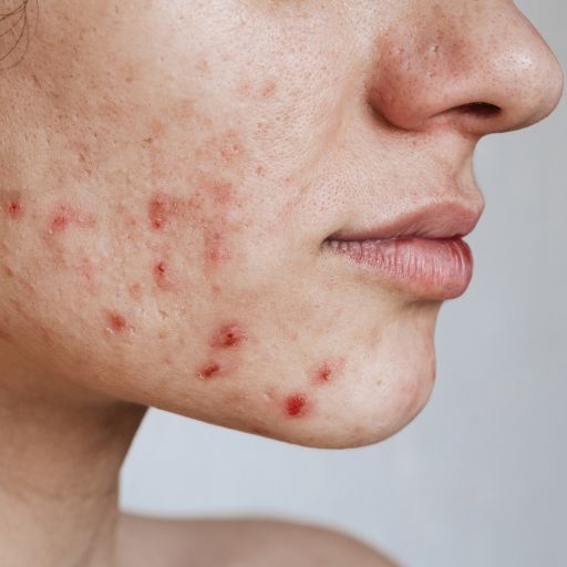 acne grau 2