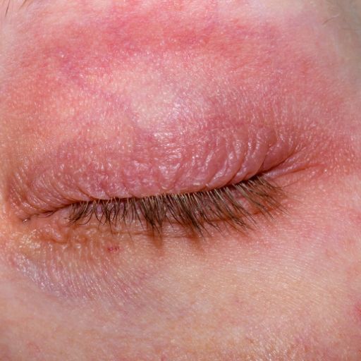 Edema Palpebral