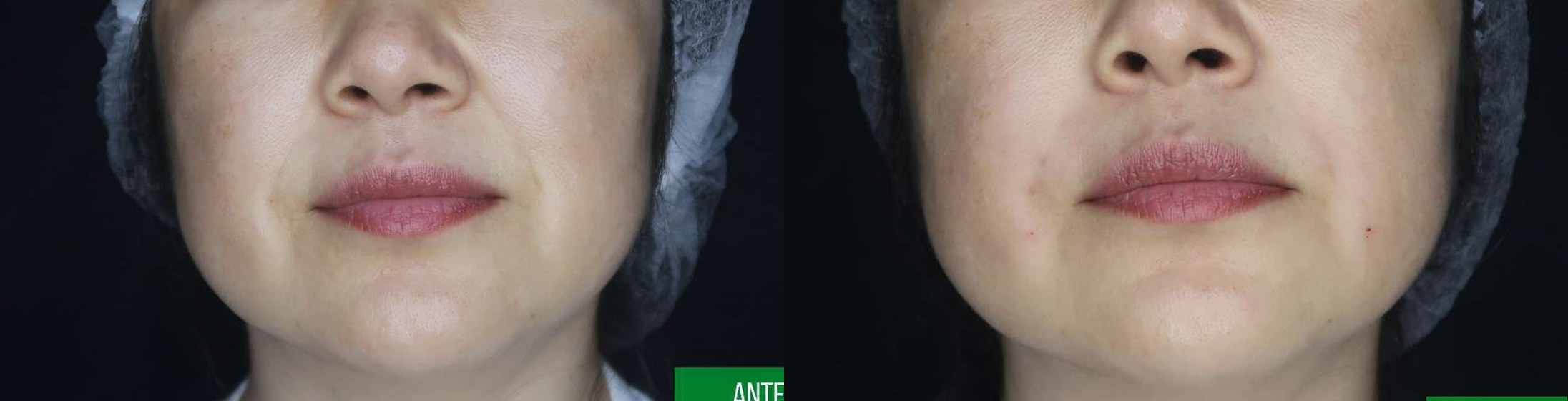 Bigode Chinês antes e depois — Caso 01 · Estética Batel