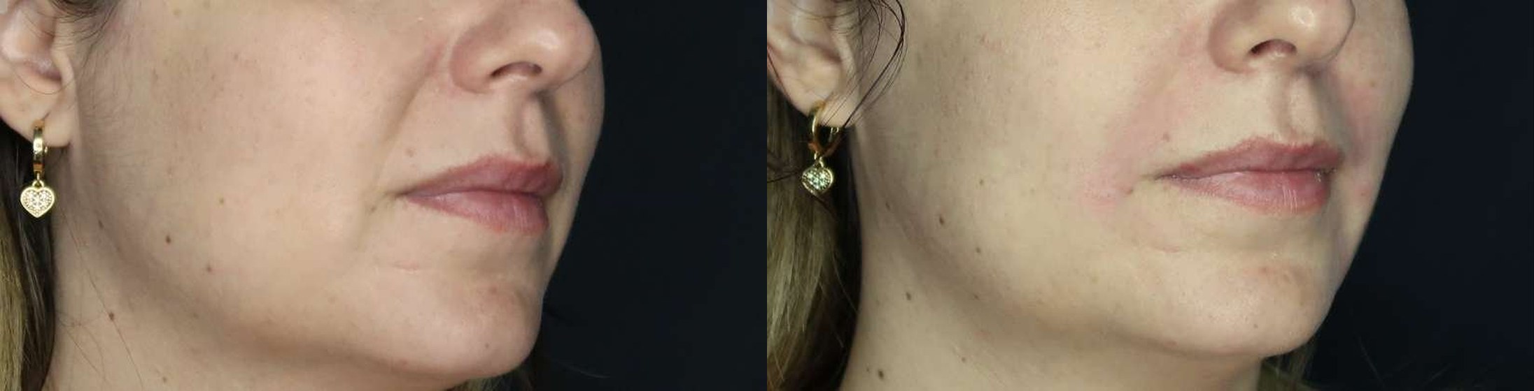 Bigode Chinês antes e depois — Caso 02 · Estética Batel