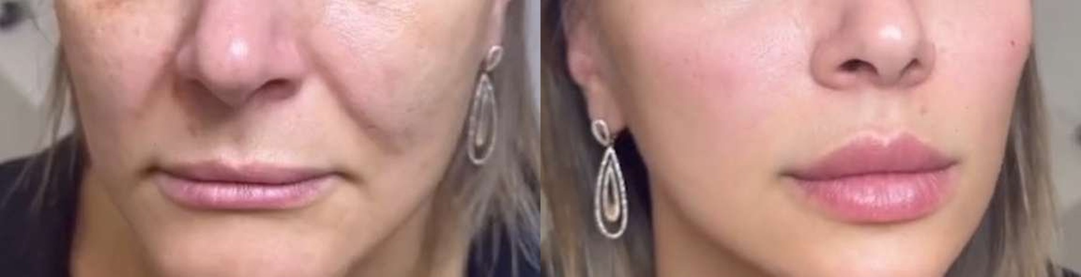Bigode Chinês antes e depois — Caso 03 · Estética Batel