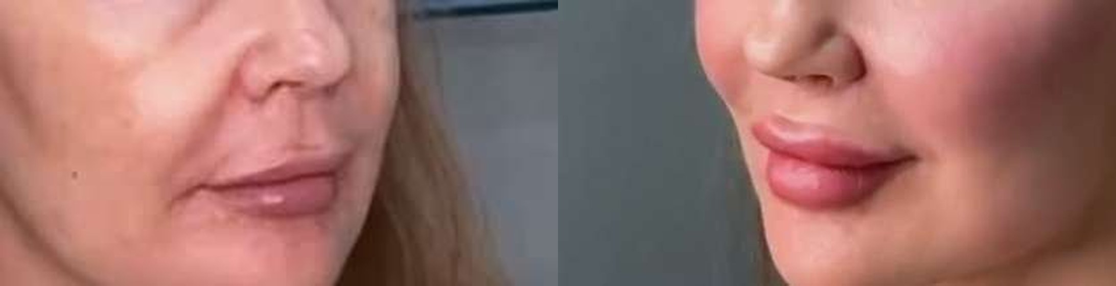 Bigode Chinês antes e depois — Caso 04 · Estética Batel