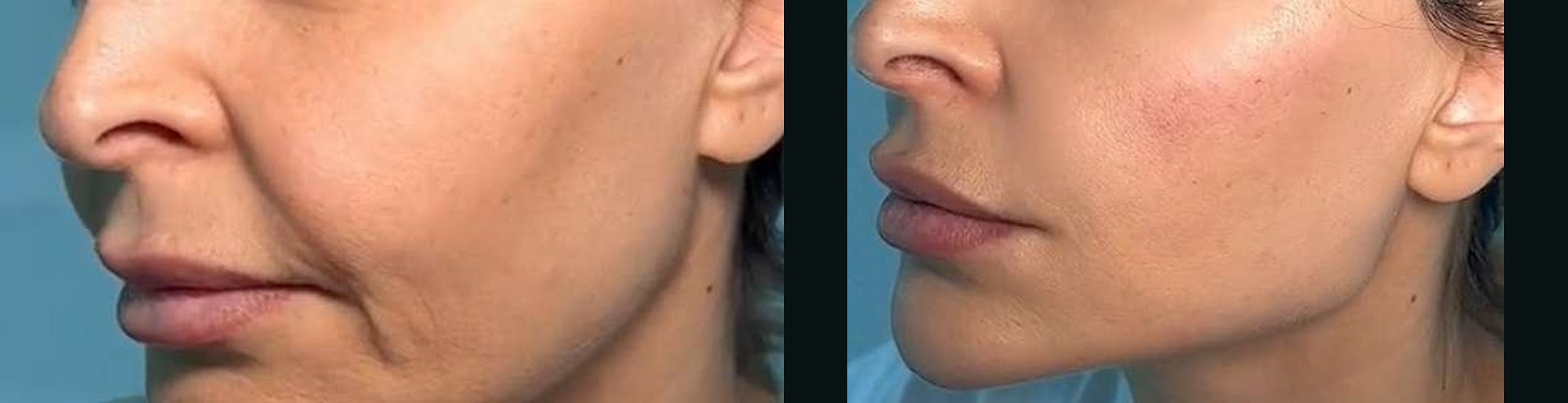 Bigode Chinês antes e depois — Caso 05 · Estética Batel