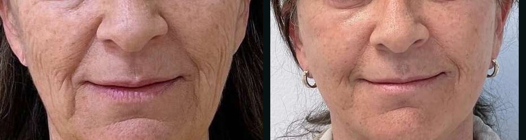 Bigode Chinês antes e depois — Caso 06 · Estética Batel