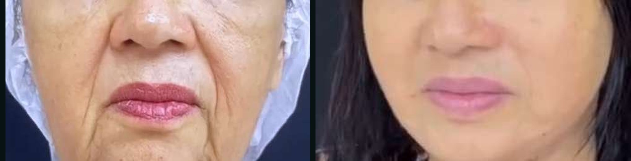 Bigode Chinês antes e depois — Caso 07 · Estética Batel