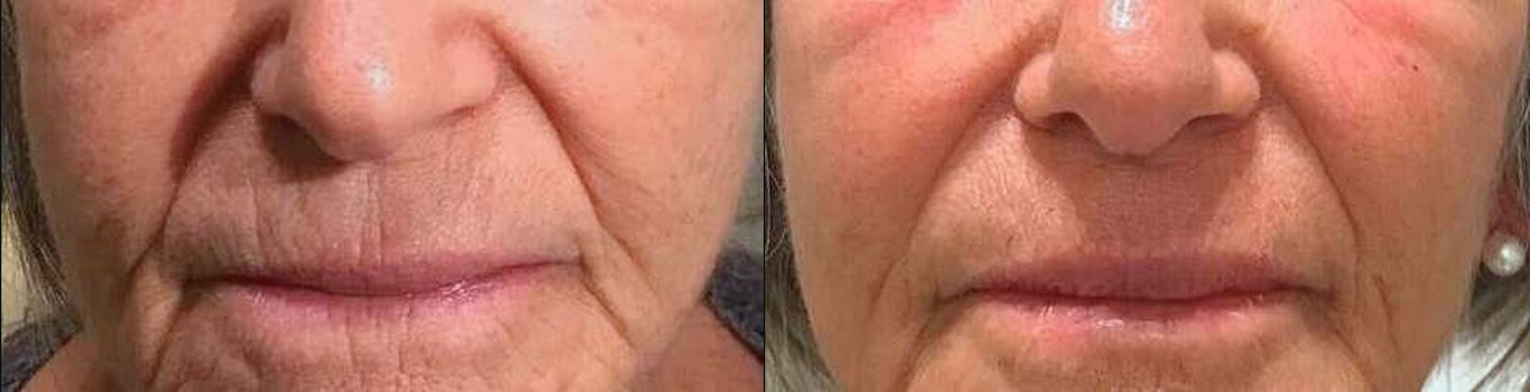 Bigode Chinês antes e depois — Caso 08 · Estética Batel