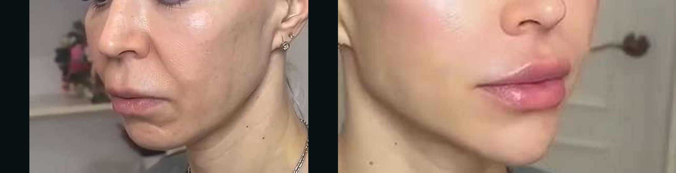 Bigode Chinês antes e depois — Caso 09 · Estética Batel