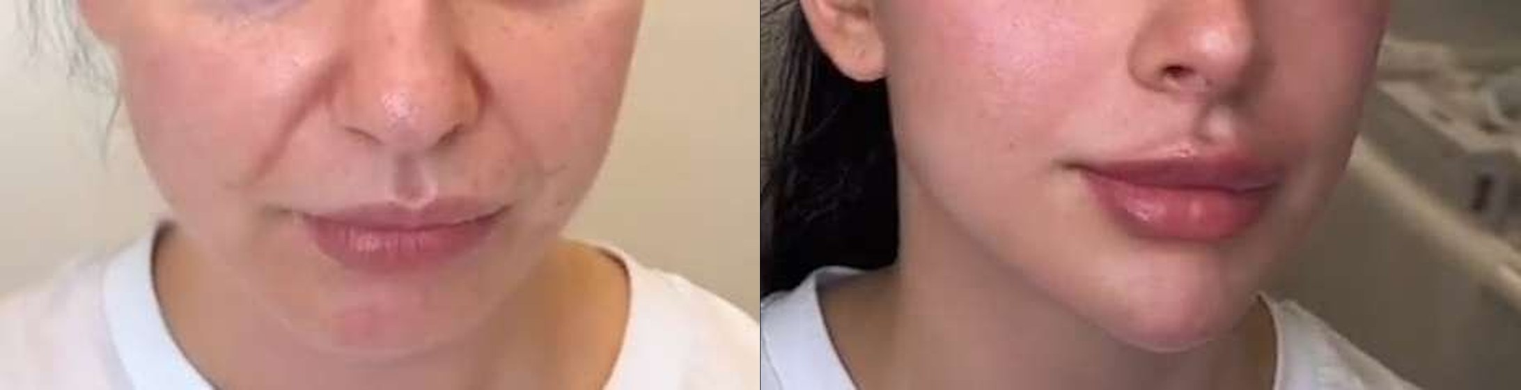 Bigode Chinês antes e depois — Caso 10 · Estética Batel