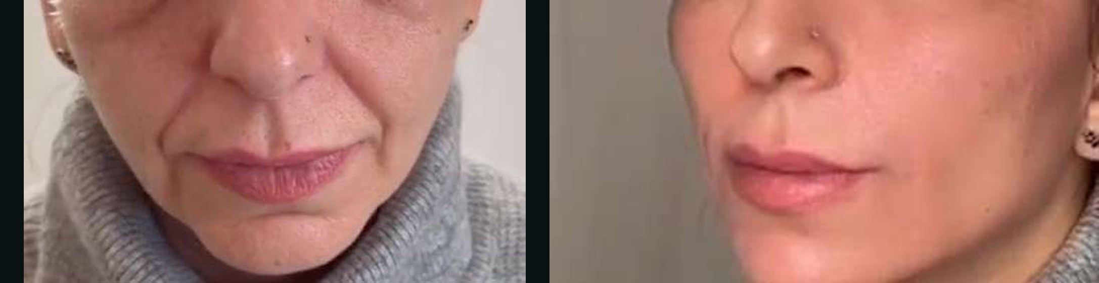 Bigode Chinês antes e depois — Caso 11 · Estética Batel