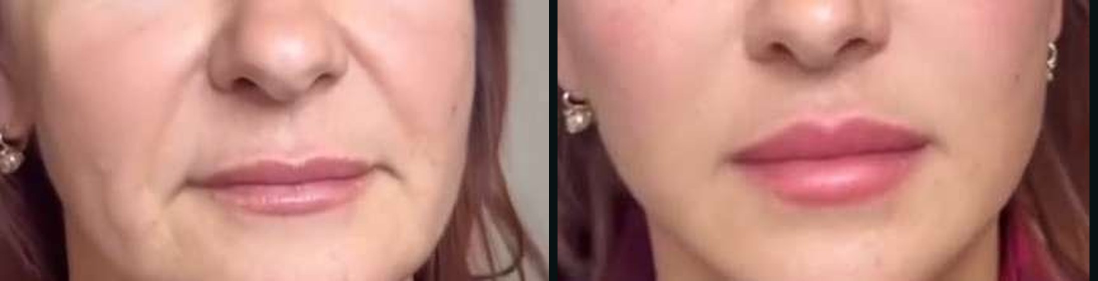 Bigode Chinês antes e depois — Caso 12 · Estética Batel