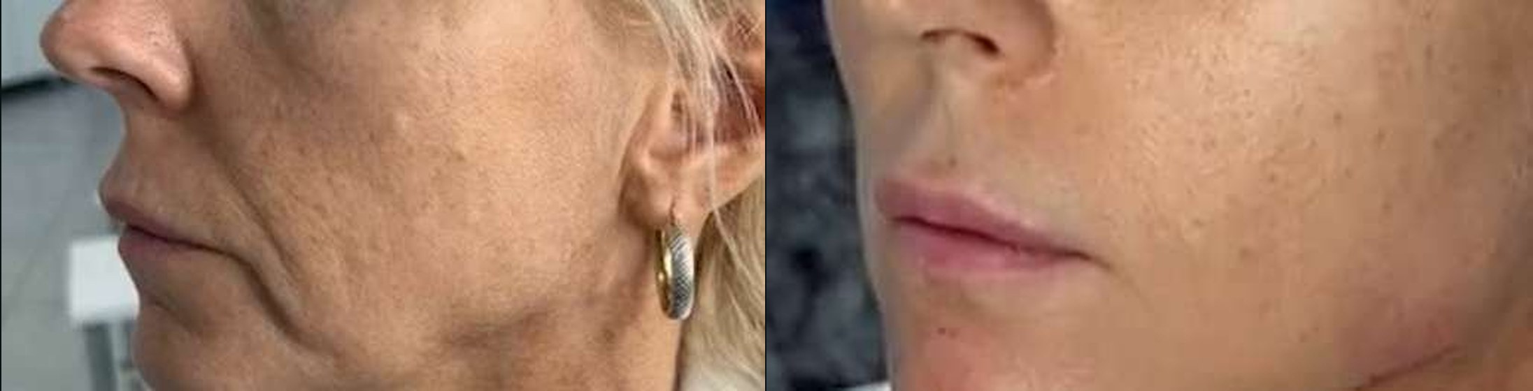 Bigode Chinês antes e depois — Caso 13 · Estética Batel