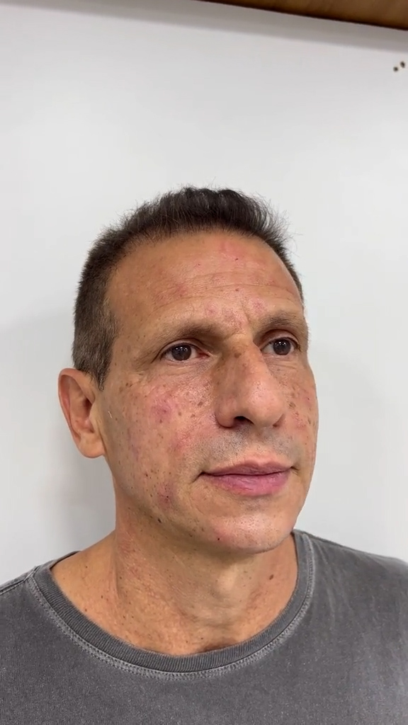 Depois - Bigode Chinês - Est&eacute;tica Batel Curitiba