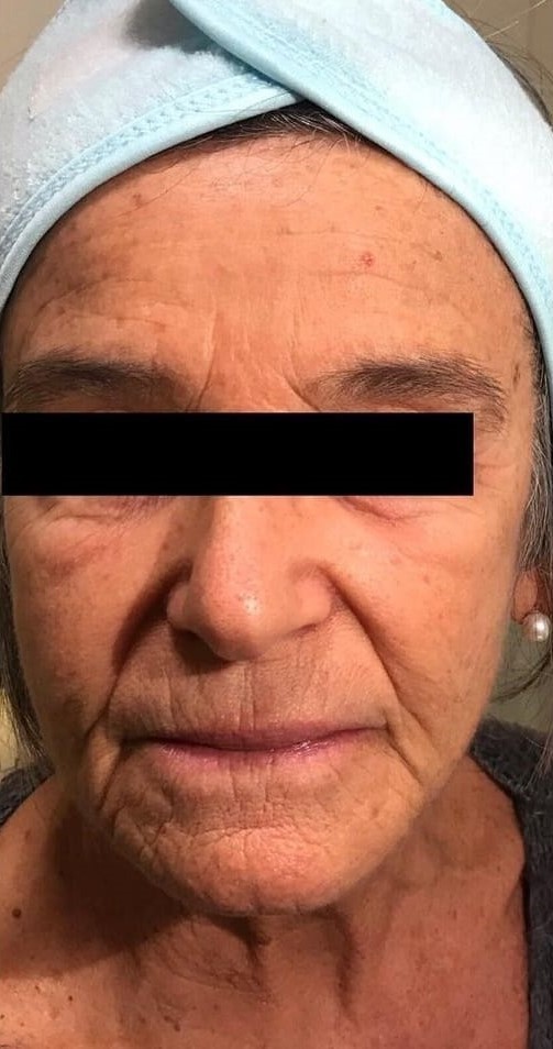 Antes - Bigode Chinês caso 86