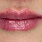Resultado de preenchimento labial