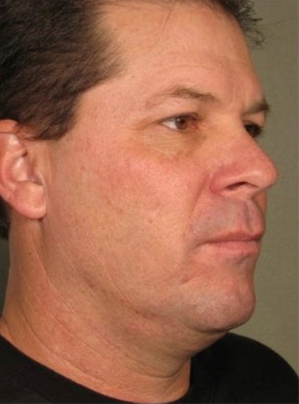 Antes - Harmonização Facial caso 13