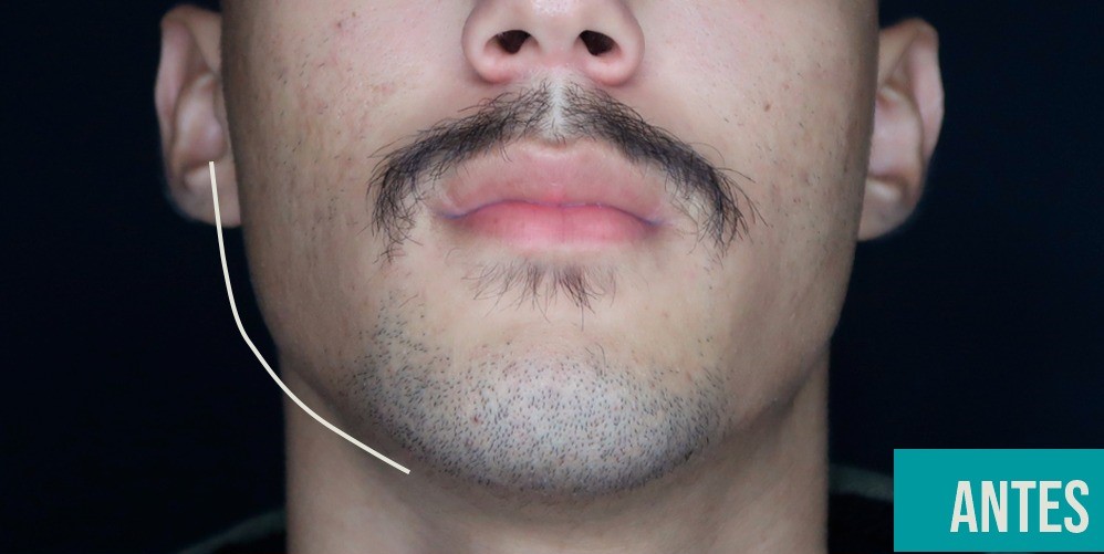 Antes - Harmonização Facial caso 14