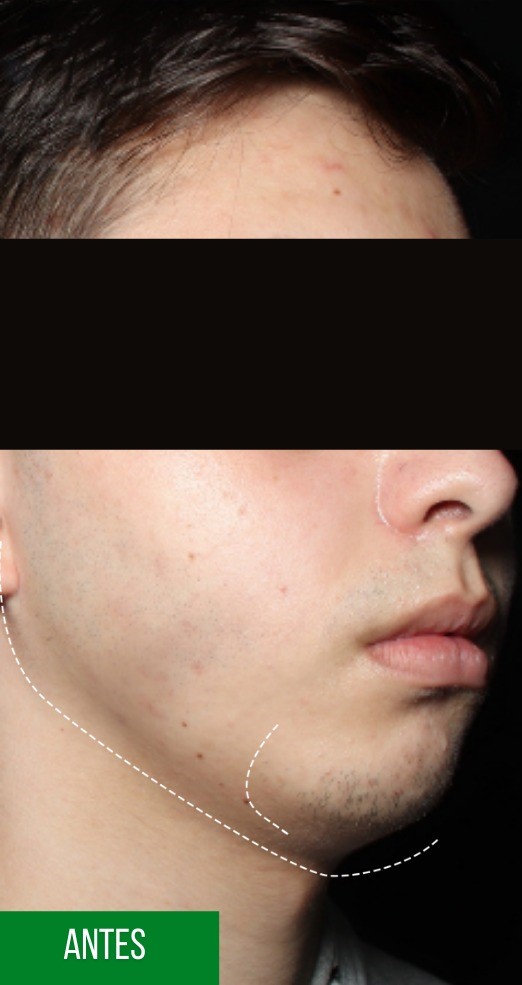 Antes - Harmonização Facial - Est&eacute;tica Batel Curitiba