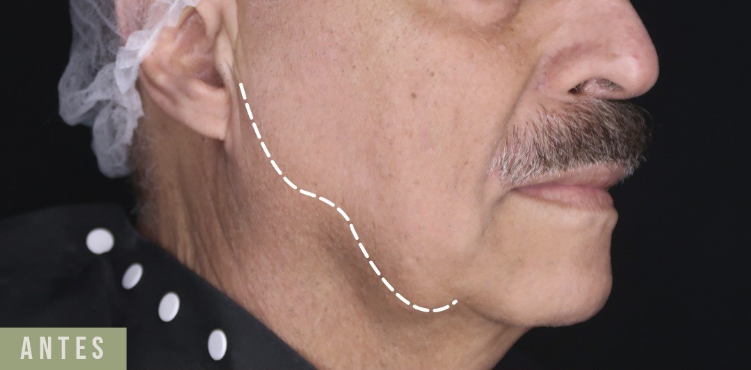 Antes - Harmonização Facial caso 16
