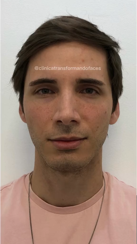 Antes - Harmonização Facial caso 18