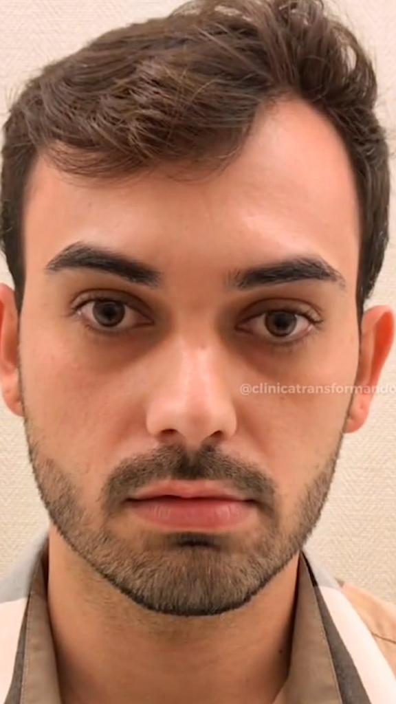 Antes - Harmonização Facial - Est&eacute;tica Batel Curitiba