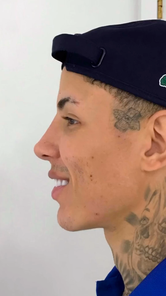 Depois - Harmonização Facial - Est&eacute;tica Batel Curitiba
