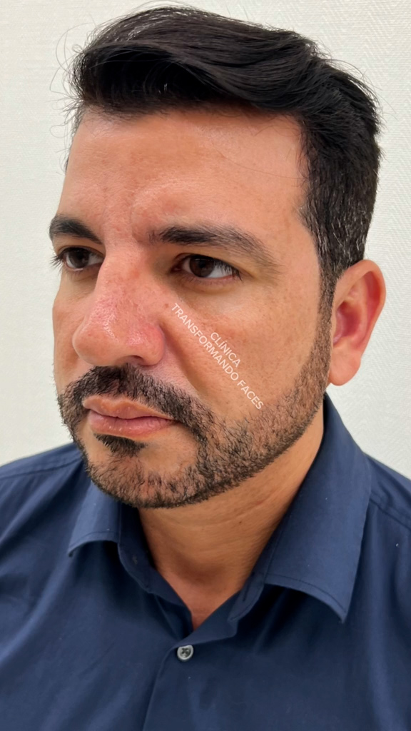 Antes - Harmonização Facial caso 26