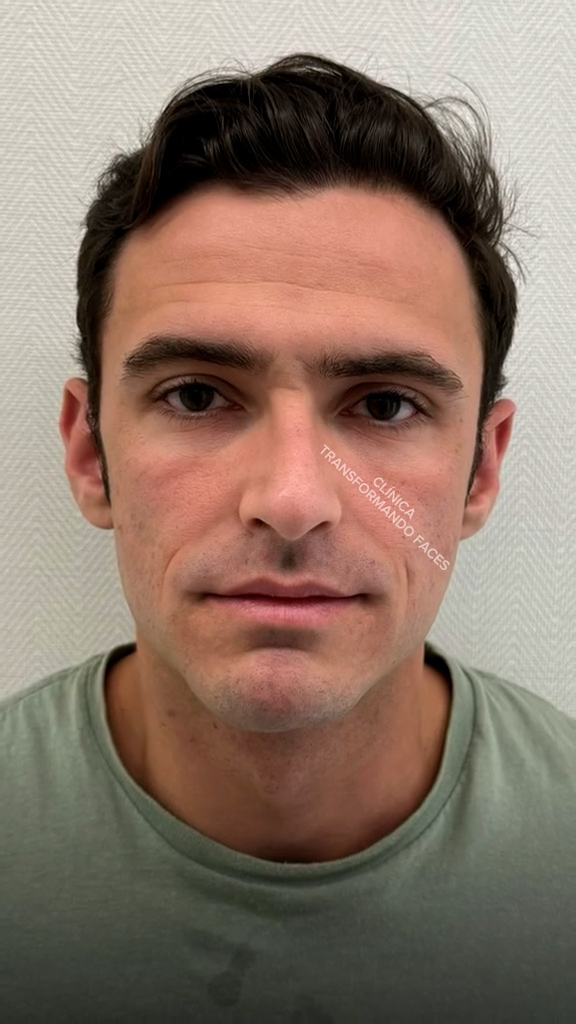 Antes - Harmonização Facial - Est&eacute;tica Batel Curitiba