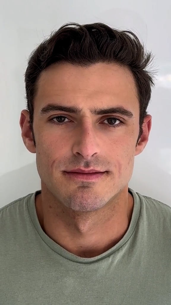 Depois - Harmonização Facial - Est&eacute;tica Batel Curitiba