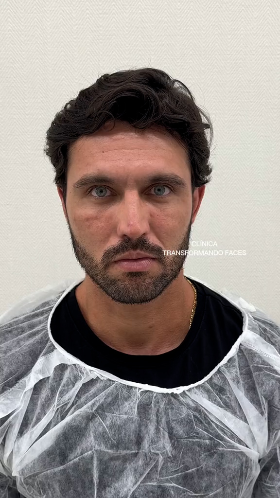 Antes - Harmonização Facial caso 30
