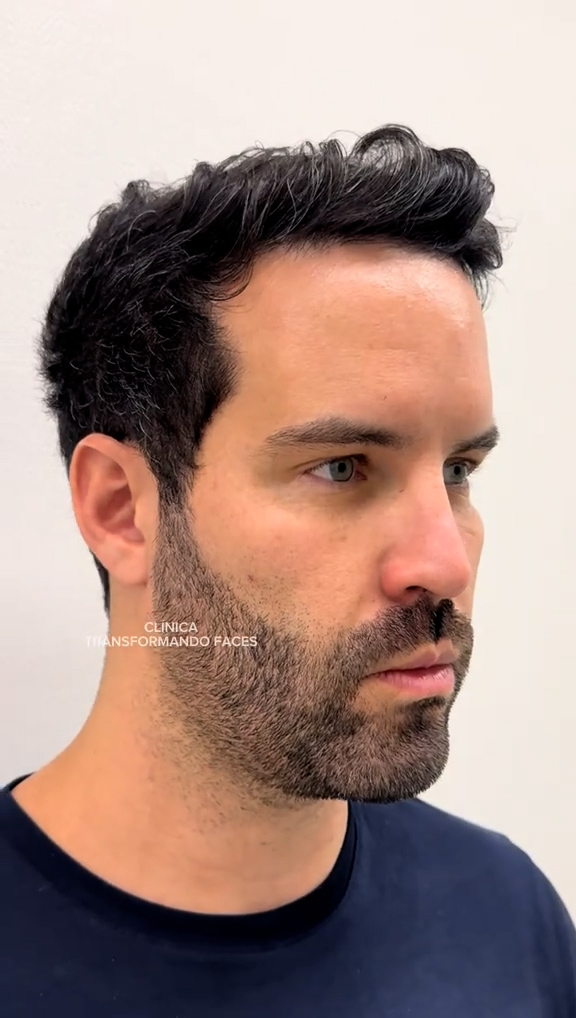 Antes - Harmonização Facial - Est&eacute;tica Batel Curitiba