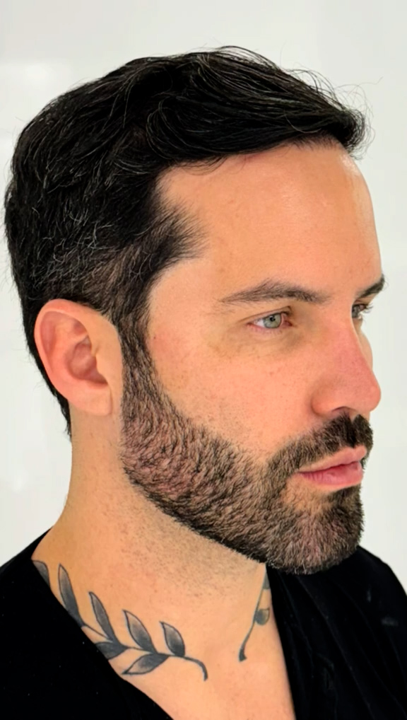 Caso 32 - Harmonização do contorno masculino no perfil