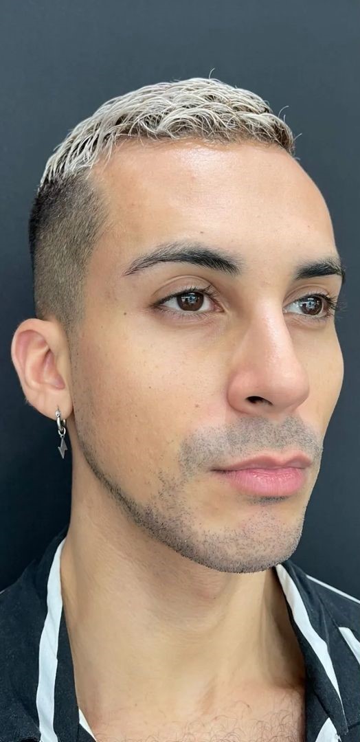 Antes - Harmonização Facial - Est&eacute;tica Batel Curitiba