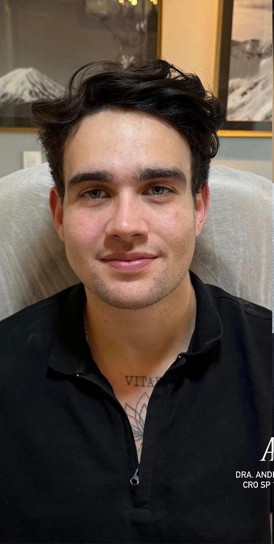 Antes - Harmonização Facial - Est&eacute;tica Batel Curitiba