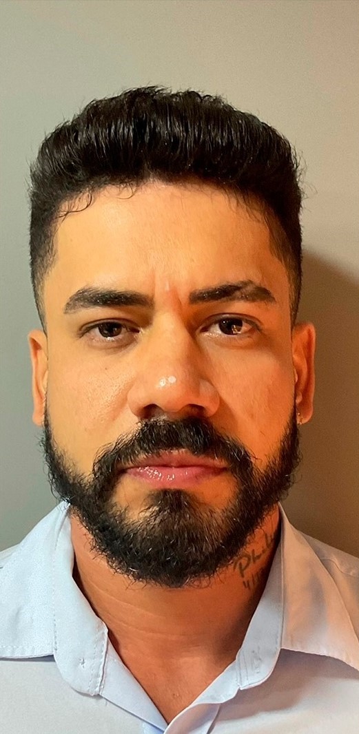 Antes - Harmonização Facial caso 39