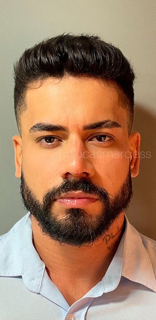 Depois - Harmonização Facial caso 39