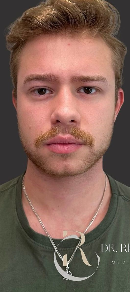 Antes - Harmonização Facial caso 40