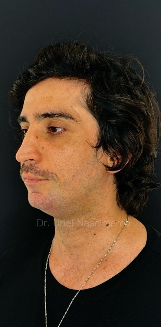 harmonizacao-homem-044 antes