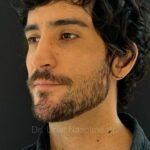 Resultado de harmonização facial masculina
