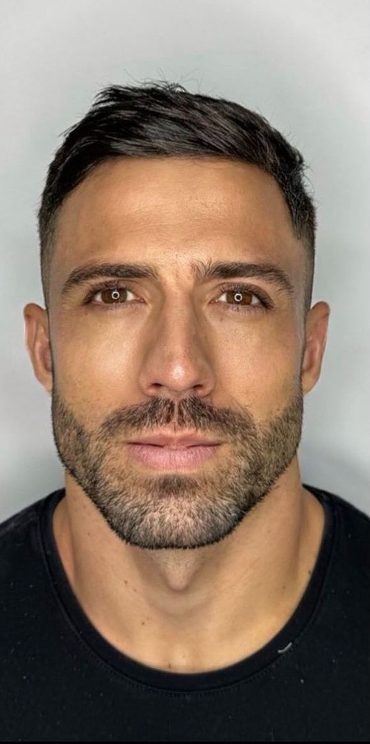 Caso 47 - Harmonização e definição da mandíbula masculina