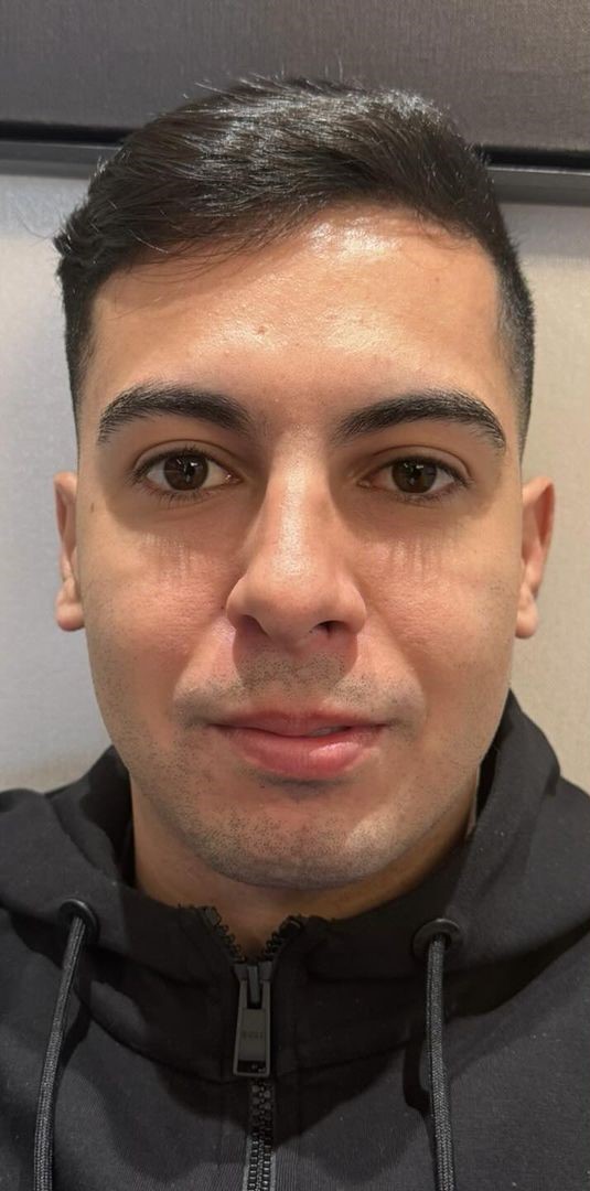 Antes - Harmonização Facial caso 59