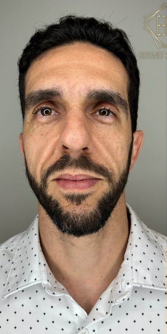 Antes - Harmonização Facial caso 61