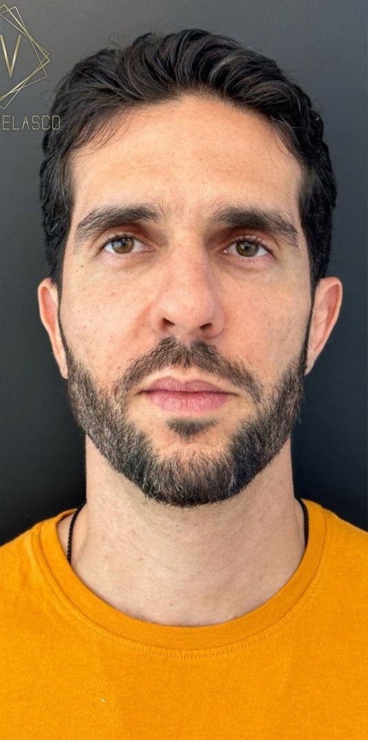 Caso 61 - Harmonização das olheiras masculinas