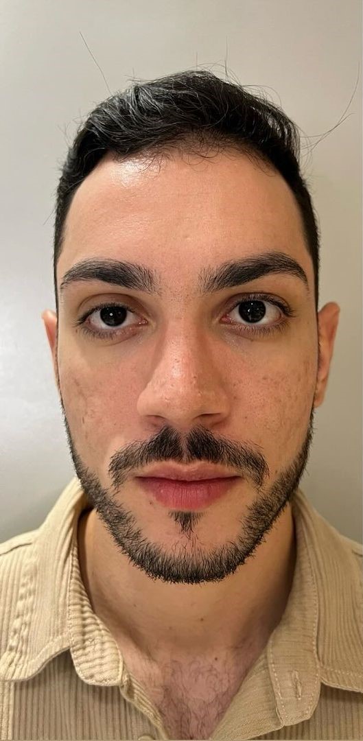 Antes - Harmonização Facial - Est&eacute;tica Batel Curitiba