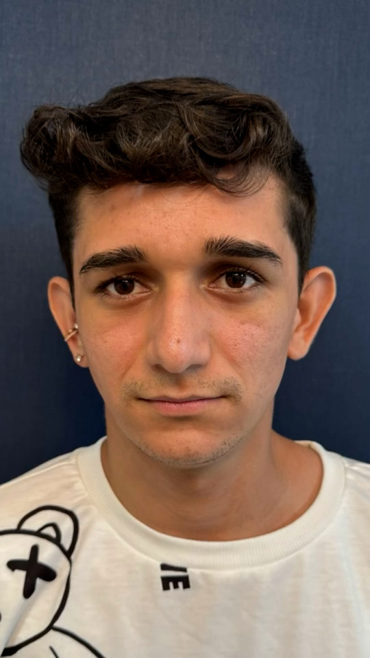 Antes - Harmonização Facial caso 78