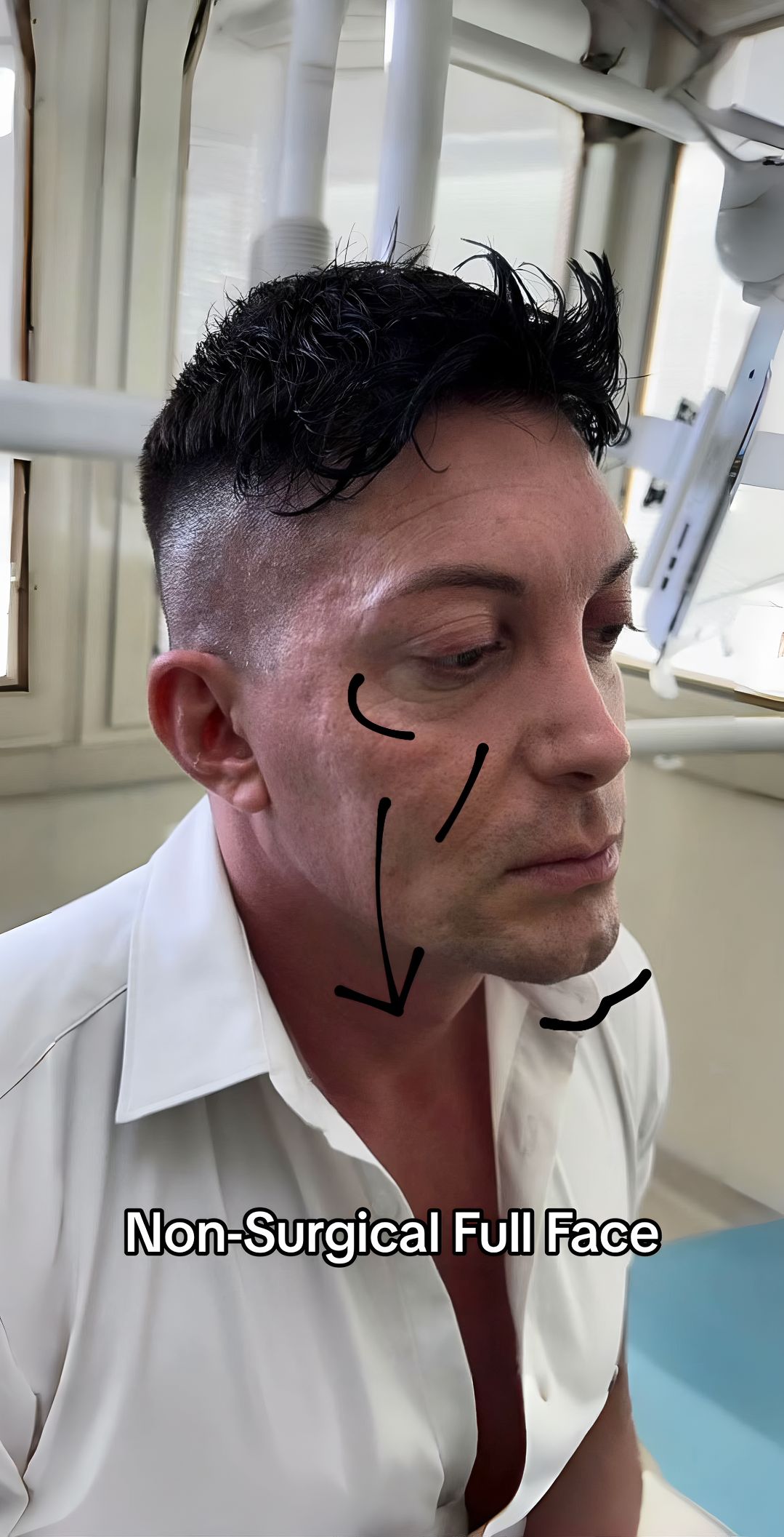 Antes - Harmonização Facial - Est&eacute;tica Batel Curitiba
