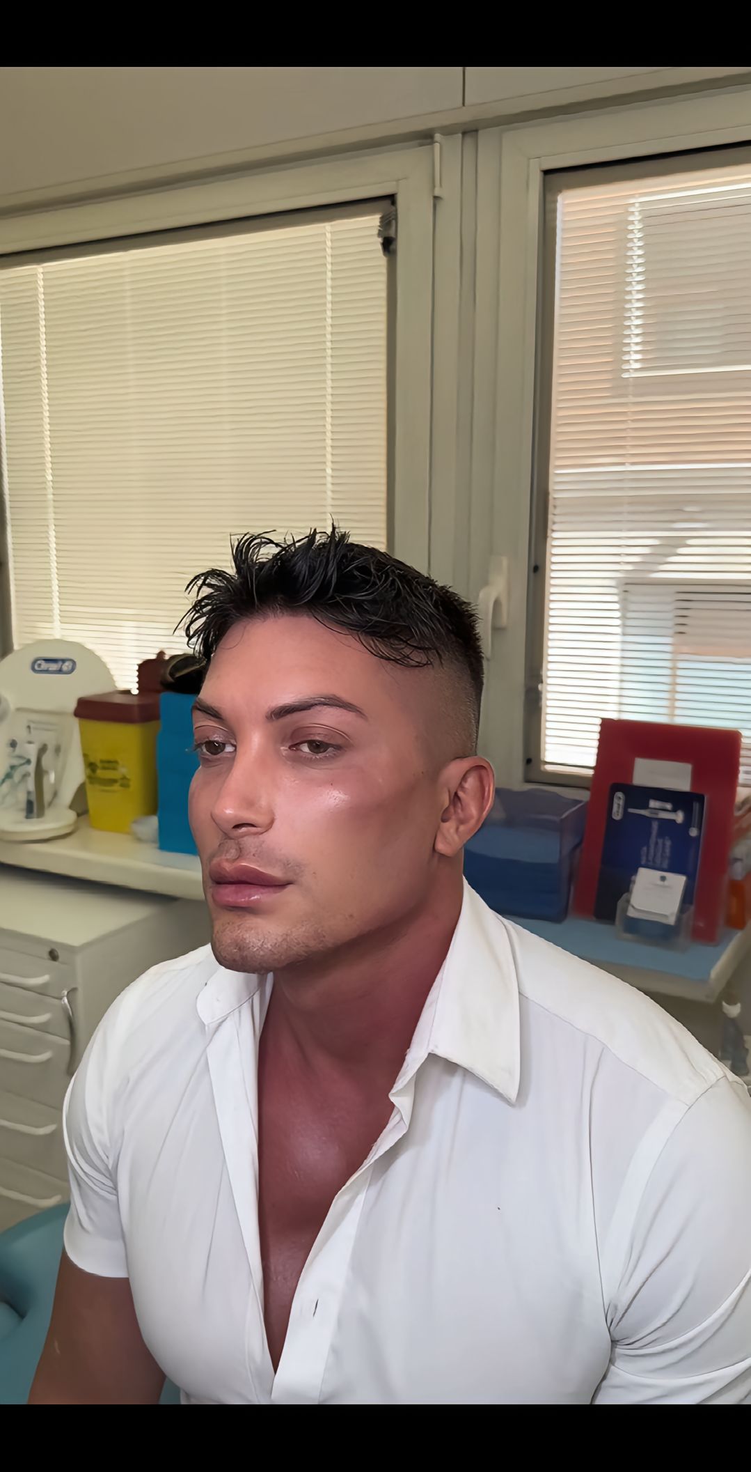 Caso 85 - Harmonização facial completa masculina