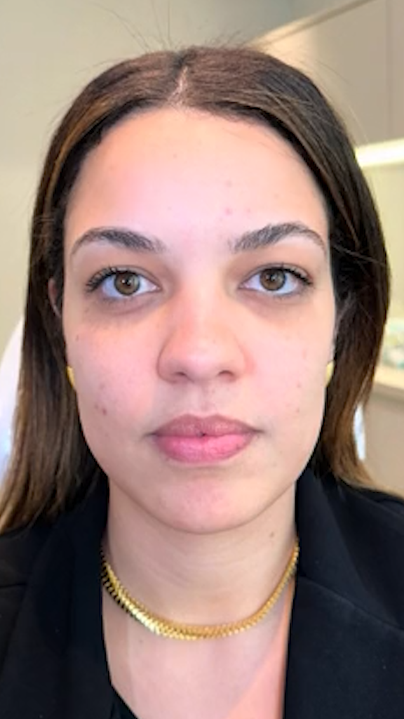 Antes - Harmonização Facial caso 01