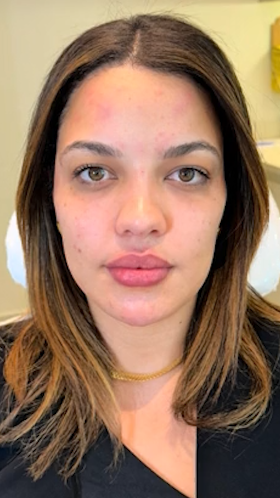 Caso 01 - Harmonização facial dos traços jovens