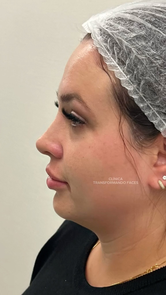 Antes - Harmonização Facial caso 29