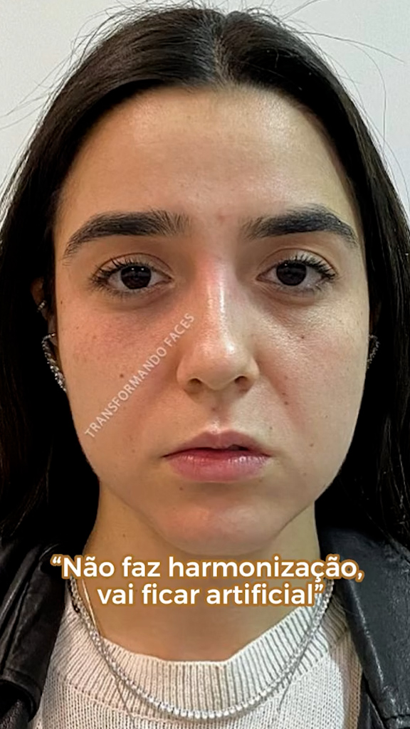 Antes - Harmonização Facial - Est&eacute;tica Batel Curitiba